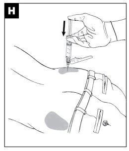 vytrol|vivitrol injection area.